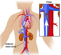 Retrievable IVC Filter Lawsuits